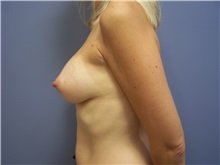 Breast Augmentation After Photo by Emily Pollard, MD; Ardmore, PA - Case 24243