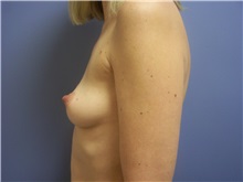 Breast Augmentation Before Photo by Emily Pollard, MD; Ardmore, PA - Case 24243