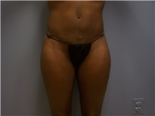 Tummy Tuck After Photo by Emily Pollard, MD; Philadelphia, PA - Case 24289