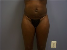 Tummy Tuck Before Photo by Emily Pollard, MD; Philadelphia, PA - Case 24289
