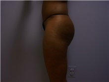Tummy Tuck After Photo by Emily Pollard, MD; Philadelphia, PA - Case 24289