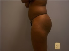 Tummy Tuck Before Photo by Emily Pollard, MD; Philadelphia, PA - Case 24289