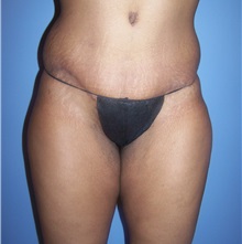 Tummy Tuck After Photo by Emily Pollard, MD; Philadelphia, PA - Case 24290