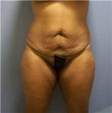 Tummy Tuck Before Photo by Emily Pollard, MD; Philadelphia, PA - Case 24290
