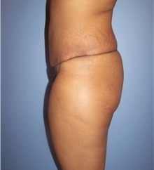 Tummy Tuck After Photo by Emily Pollard, MD; Philadelphia, PA - Case 24290