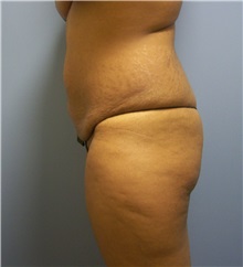 Tummy Tuck Before Photo by Emily Pollard, MD; Philadelphia, PA - Case 24290
