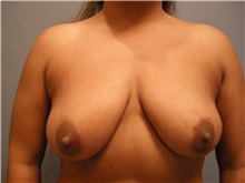 Breast Augmentation Before Photo by Emily Pollard, MD; Philadelphia, PA - Case 24835