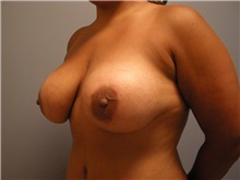 Breast Augmentation After Photo by Emily Pollard, MD; Philadelphia, PA - Case 24835