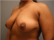 Breast Augmentation Before Photo by Emily Pollard, MD; Philadelphia, PA - Case 24835