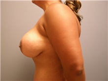 Breast Augmentation After Photo by Emily Pollard, MD; Philadelphia, PA - Case 24835