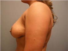 Breast Augmentation Before Photo by Emily Pollard, MD; Philadelphia, PA - Case 24835