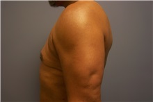 Male Breast Reduction After Photo by Emily Pollard, MD; Ardmore, PA - Case 24863