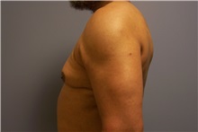 Male Breast Reduction Before Photo by Emily Pollard, MD; Ardmore, PA - Case 24863