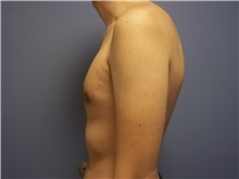 Male Breast Reduction After Photo by Emily Pollard, MD; Ardmore, PA - Case 24865