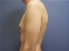 Male Breast Reduction Before Photo by Emily Pollard, MD; Ardmore, PA - Case 24865