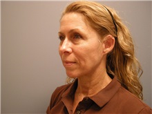 Facelift After Photo by Emily Pollard, MD; Ardmore, PA - Case 25515