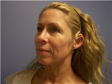 Facelift Before Photo by Emily Pollard, MD; Ardmore, PA - Case 25515