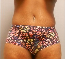 Tummy Tuck After Photo by Emily Pollard, MD; Philadelphia, PA - Case 28116