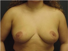 Breast Lift After Photo by Emily Pollard, MD; Ardmore, PA - Case 28145