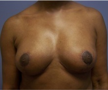 Breast Lift After Photo by Emily Pollard, MD; Ardmore, PA - Case 28146