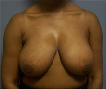 Breast Lift Before Photo by Emily Pollard, MD; Ardmore, PA - Case 28146