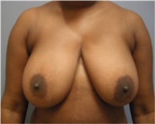 Breast Lift Before Photo by Emily Pollard, MD; Ardmore, PA - Case 28147