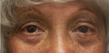 Eyelid Surgery After Photo by Emily Pollard, MD; Bala Cynwyd, PA - Case 28265