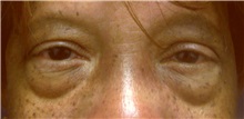 Eyelid Surgery Before Photo by Emily Pollard, MD; Bala Cynwyd, PA - Case 28265