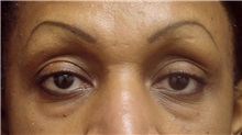 Eyelid Surgery After Photo by Emily Pollard, MD; Bala Cynwyd, PA - Case 28266