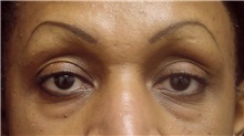 Eyelid Surgery After Photo by Emily Pollard, MD; Ardmore, PA - Case 28266