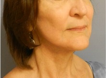 Facelift After Photo by Emily Pollard, MD; Bala Cynwyd, PA - Case 28268