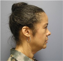 Facelift Before Photo by Emily Pollard, MD; Ardmore, PA - Case 28273