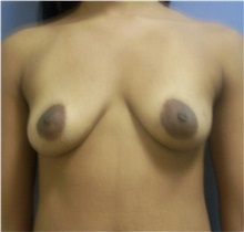 Breast Augmentation Before Photo by Emily Pollard, MD; Ardmore, PA - Case 29654