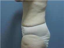 Tummy Tuck After Photo by Emily Pollard, MD; Ardmore, PA - Case 31723