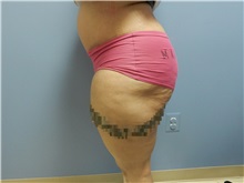 Tummy Tuck After Photo by Emily Pollard, MD; Ardmore, PA - Case 31774