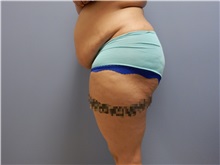 Tummy Tuck Before Photo by Emily Pollard, MD; Ardmore, PA - Case 31774