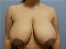 Breast Reduction Before Photo by Emily Pollard, MD; ,  - Case 32952