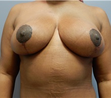 Breast Lift After Photo by Emily Pollard, MD; Ardmore, PA - Case 35180