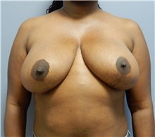 Breast Lift Before Photo by Emily Pollard, MD; Ardmore, PA - Case 35180