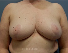 Breast Reduction After Photo by Emily Pollard, MD; Bala Cynwyd, PA - Case 35250
