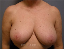 Breast Reduction Before Photo by Emily Pollard, MD; Ardmore, PA - Case 35250