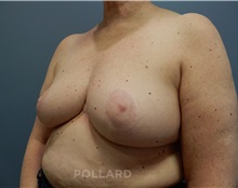 Breast Reduction After Photo by Emily Pollard, MD; Ardmore, PA - Case 35250