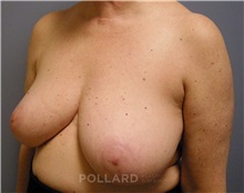Breast Reduction Before Photo by Emily Pollard, MD; Ardmore, PA - Case 35250