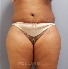 Tummy Tuck After Photo by Emily Pollard, MD; Philadelphia, PA - Case 37453