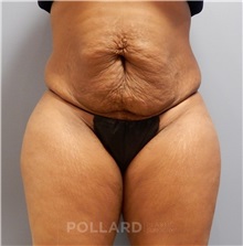 Tummy Tuck Before Photo by Emily Pollard, MD; Philadelphia, PA - Case 37453
