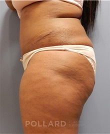 Tummy Tuck After Photo by Emily Pollard, MD; Philadelphia, PA - Case 37453