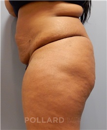 Tummy Tuck Before Photo by Emily Pollard, MD; Philadelphia, PA - Case 37453