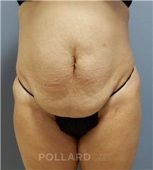 Mommy Makeover Before Photo by Emily Pollard, MD; Philadelphia, PA - Case 37483