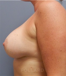 Breast Augmentation After Photo by Emily Pollard, MD; Ardmore, PA - Case 37575