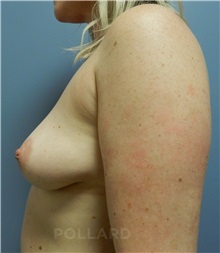Breast Augmentation Before Photo by Emily Pollard, MD; Ardmore, PA - Case 37575